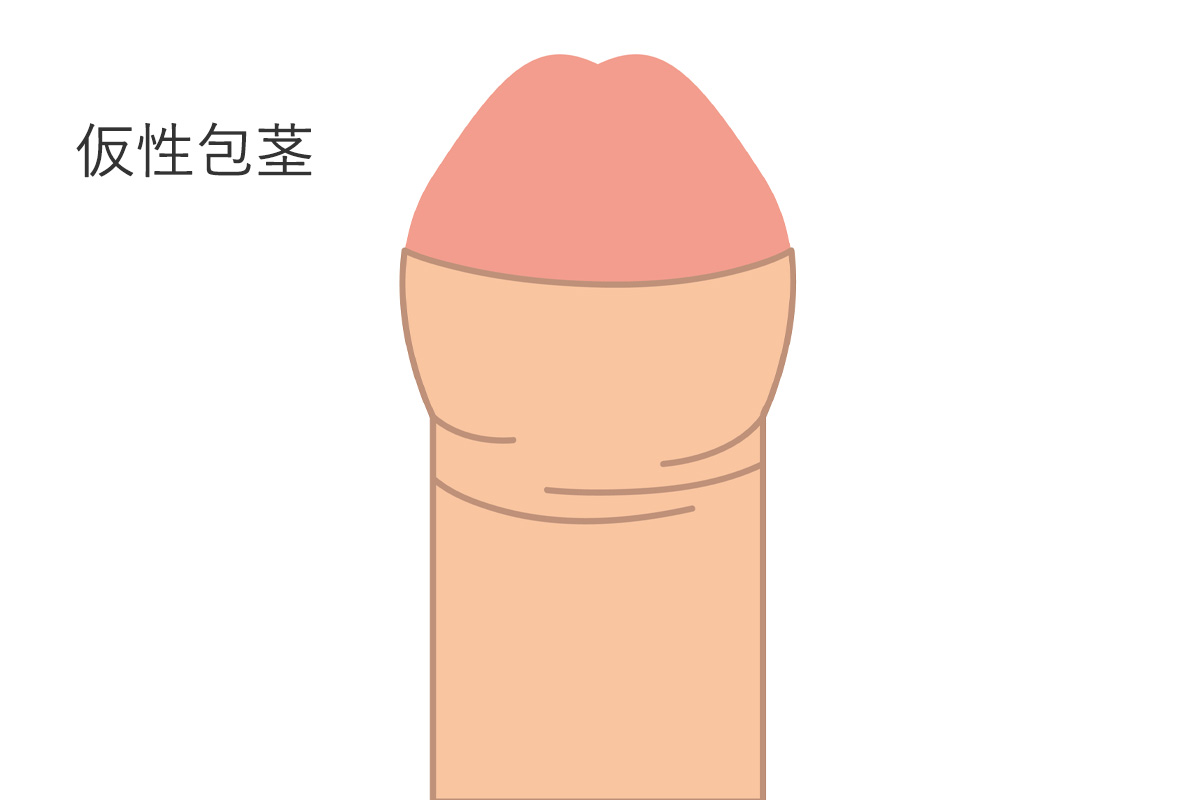 仮性包茎