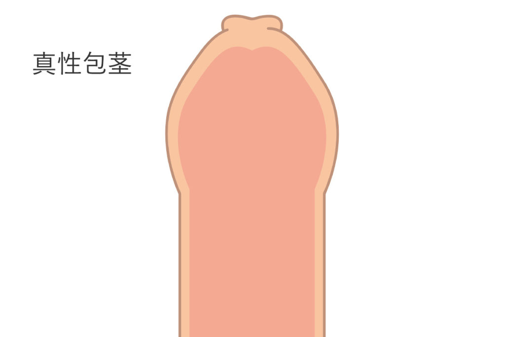 真性包茎