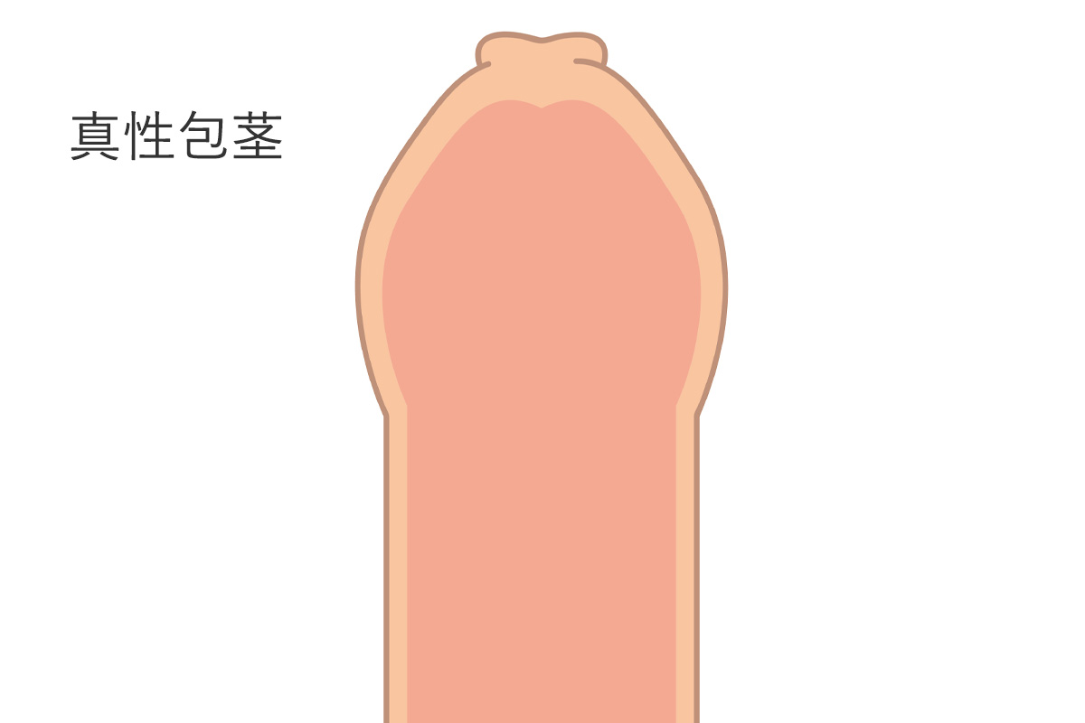 真性包茎