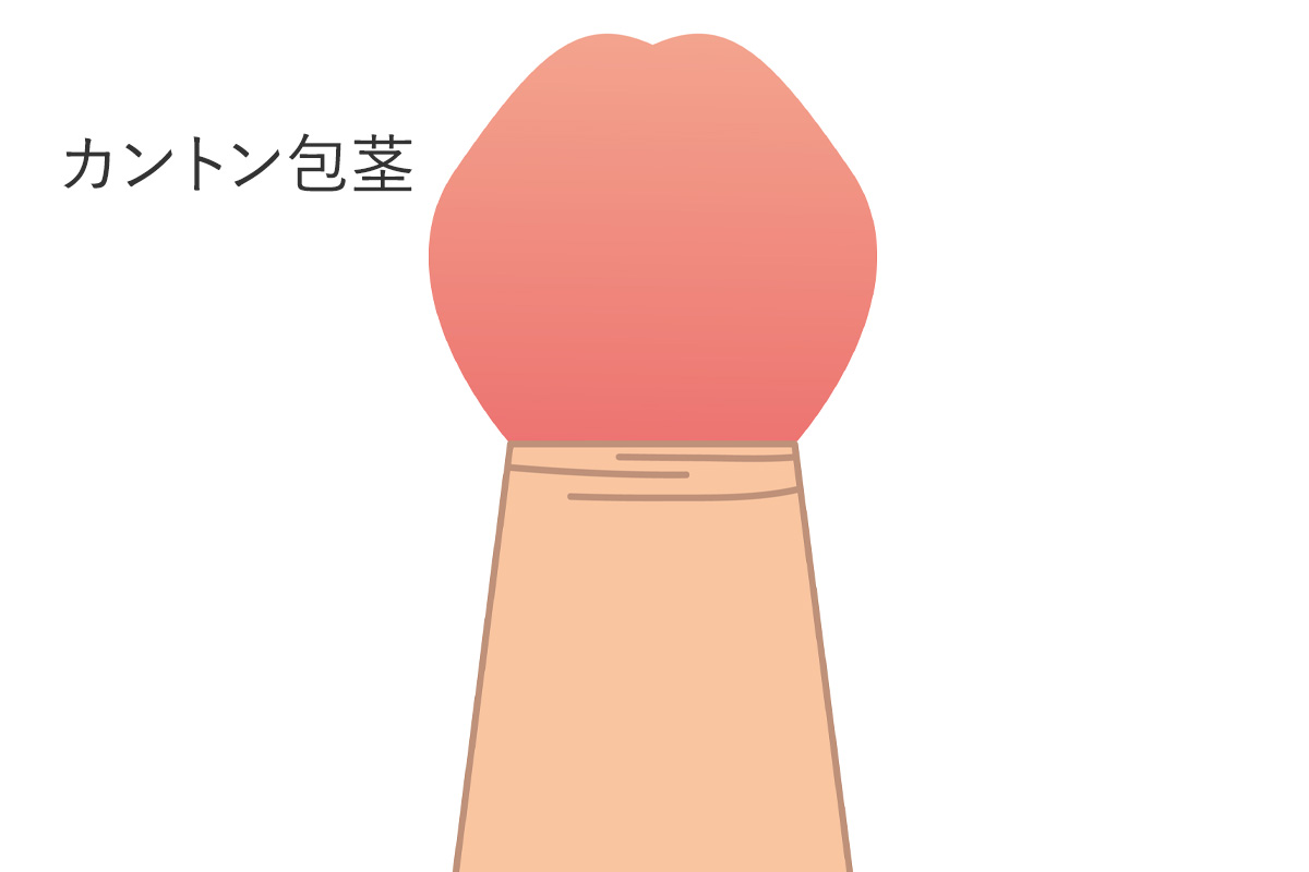 カントン包茎（カントン状態）
