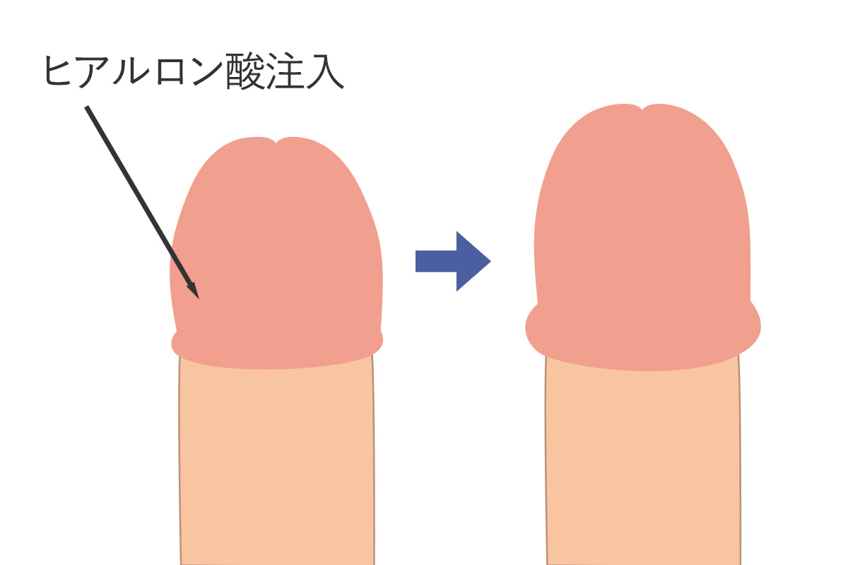 亀頭増大（ヒアルロン酸注入）術