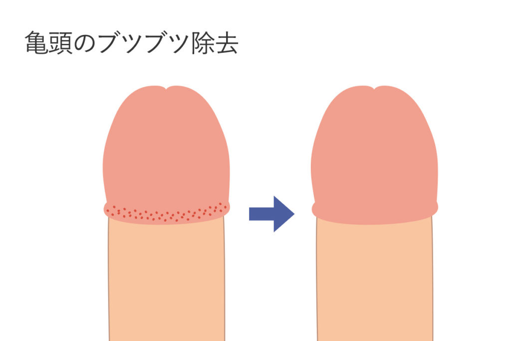 亀頭のブツブツ（真珠様陰茎小丘疹・フォアダイス）除去