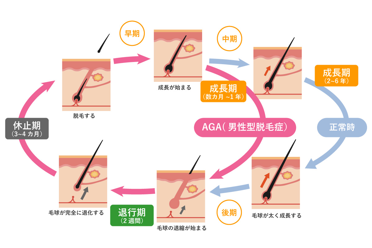男性型脱毛症・AGAのヘアサイクル