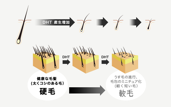 DHT(男性ホルモン)の産生増加による薄毛のメカニズム