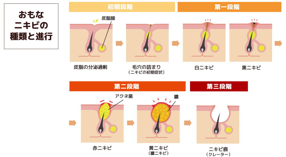 ニキビの種類