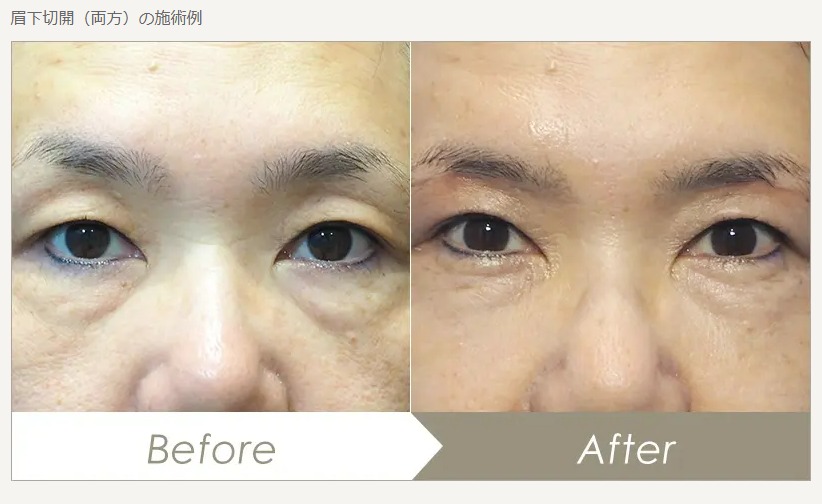 眉下切開手術の男性患者様のビフォーアフター画像