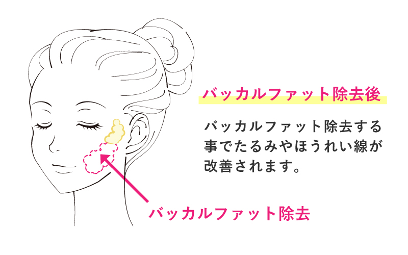 バッカルファット（頬脂肪）除去術の解説画像