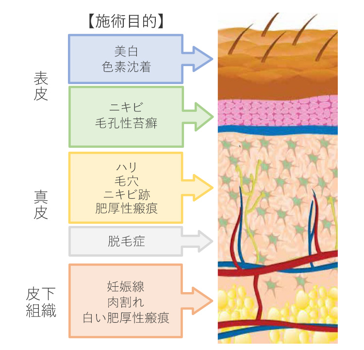 ダーマペンで治療できる皮膚の層