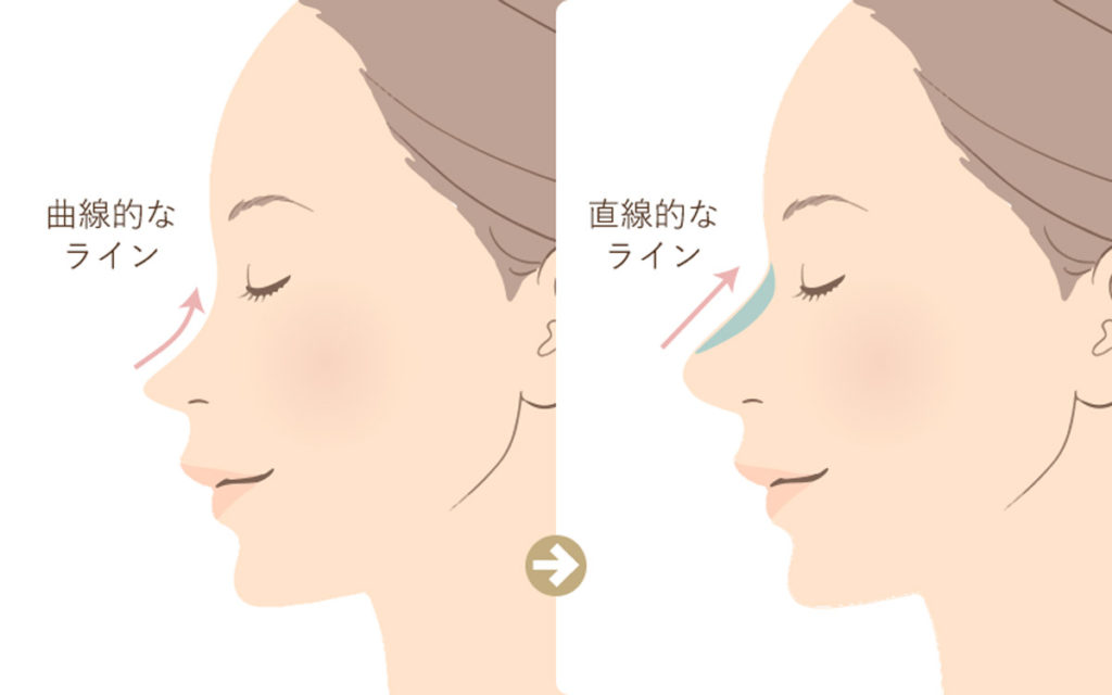 鼻ヒアルロン酸注射は鼻筋を通し高さを出すことが可能な鼻のプチ整形