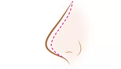 鼻プロテーゼで鼻を高くする整形
