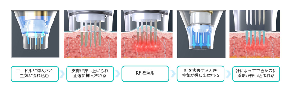 RF技術を使用したポテンツァのニードルデバイスが、皮膚に微細な穴を開けて薬剤を浸透させる仕組みを説明した図