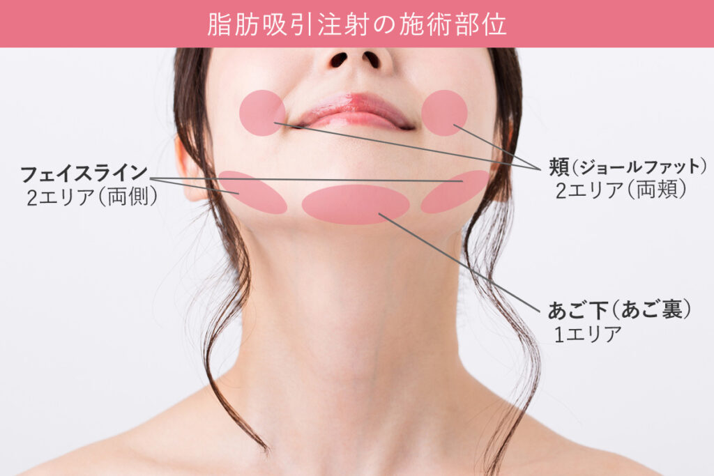 脂肪吸引注射（顔）の施術部位