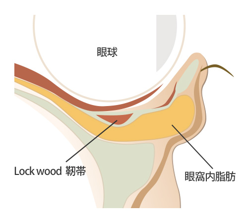 下眼瞼脂肪の模式図