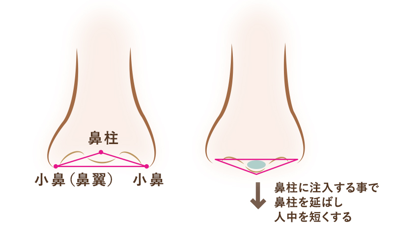 鼻柱にヒアルロン酸を注入することで、鼻の穴を目立ちにくくする