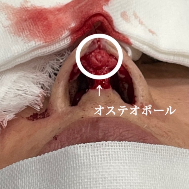 オステオポール除去前の鼻の手術中画像