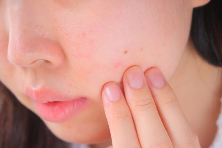 ビタミンA反応(レチノイド反応)による肌の赤み