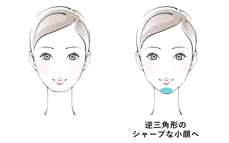 顎にヒアルロン酸を注入すると、逆三角形のシャープな小顔になります