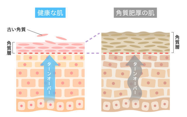 ターンオーバー