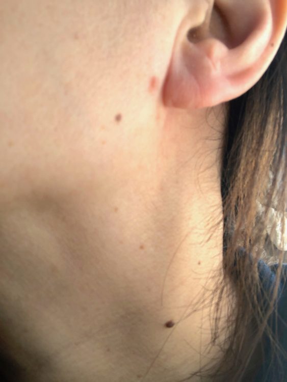 脂漏性角化症は厚みのあるシミ