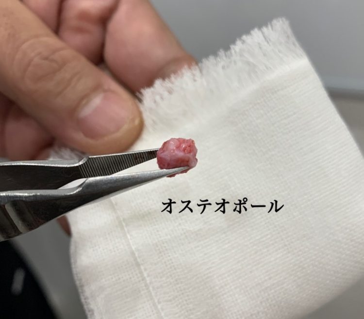 鼻から除去したオステオポール