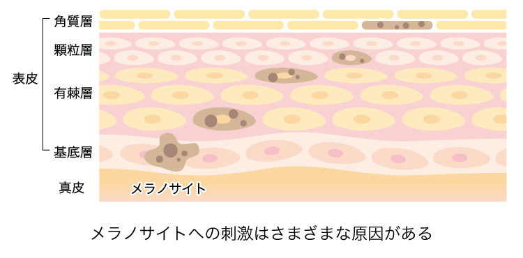 メラノサイトへ刺激を与える原因