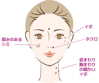電気焼灼器（モノポーラー）で厚みのあるほくろやイボの悩みを解消