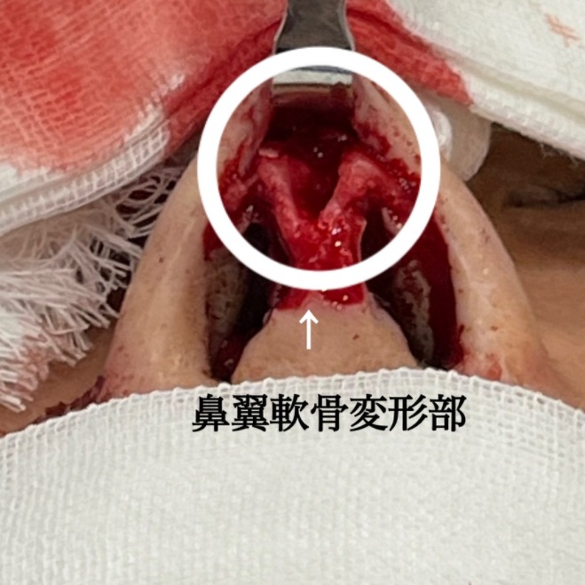 オステオポールによって変形した鼻翼軟骨の画像