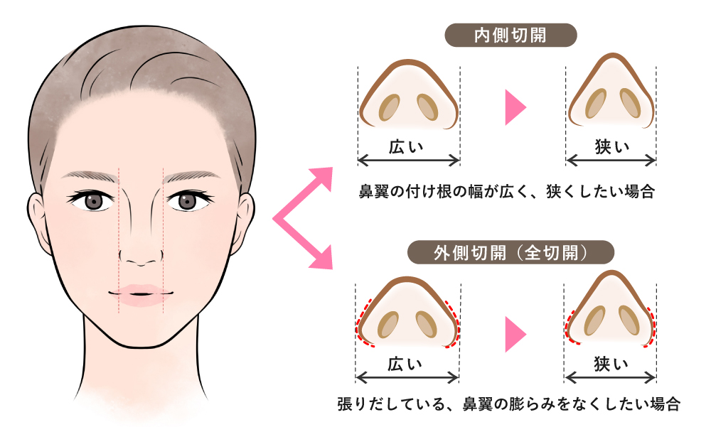 小鼻縮小整形の内側切開と外側切開