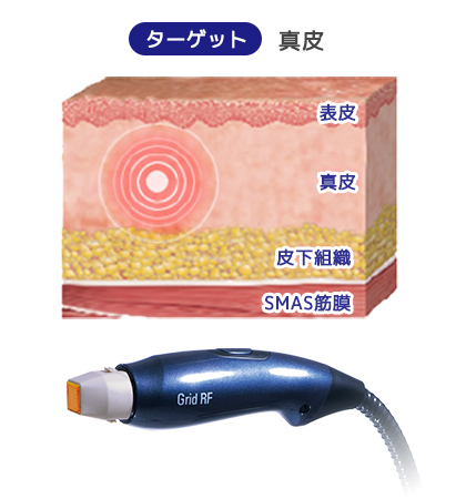 イントラジェンは真皮層をターゲットに照射