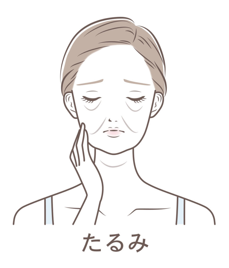 たるみ