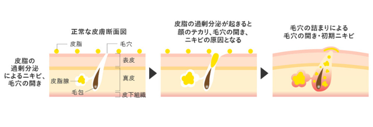 毛穴の開き