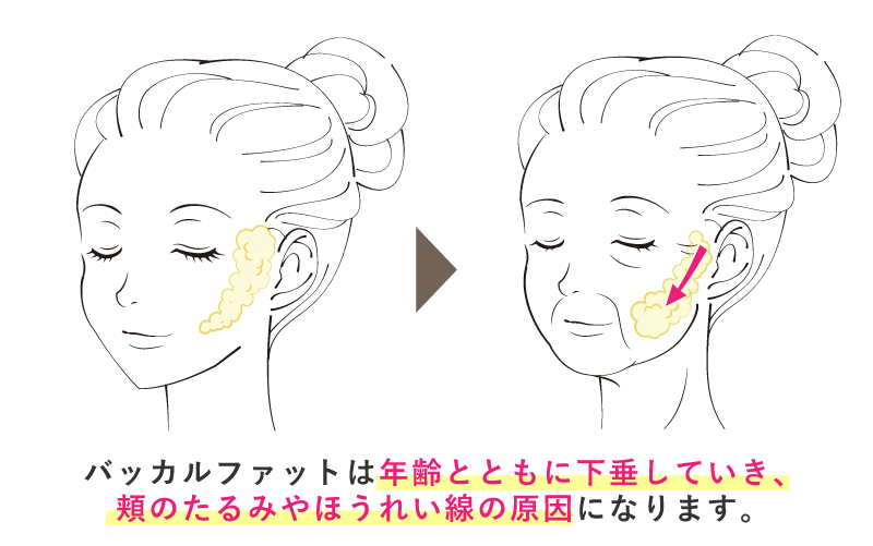 バッカルファットが年齢とともに下垂することで、頬のたるみやほうれい線ができる