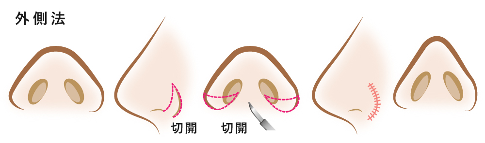 小鼻縮小整形 外側切開（全切開）