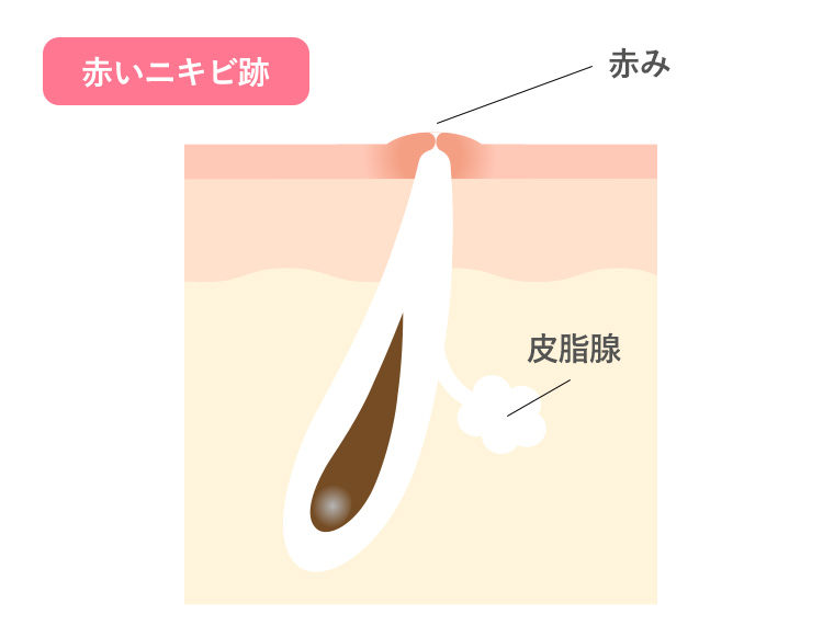 赤いニキビ跡は赤ニキビが長時間続くとニキビ自体が治っても肌内部で炎症が続き跡として数カ月残ります
