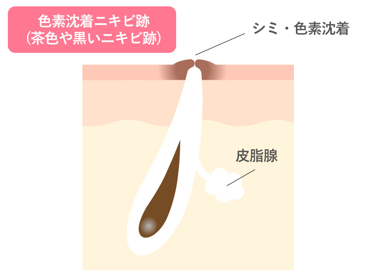 色素沈着ニキビ跡(茶色や黒いニキビ跡)はニキビが治った後もメラニン色素がお肌に沈着し、茶色や黒色のシミのように見える状態
