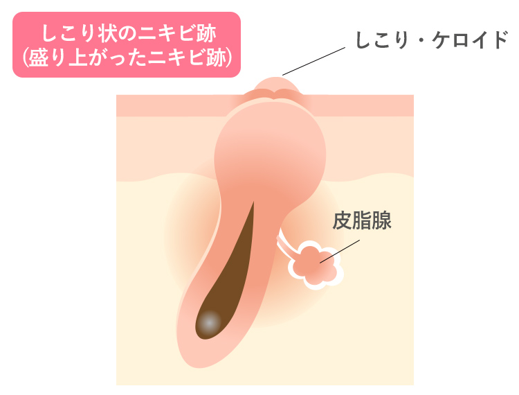しこり状のニキビ跡(盛り上がったニキビ跡)