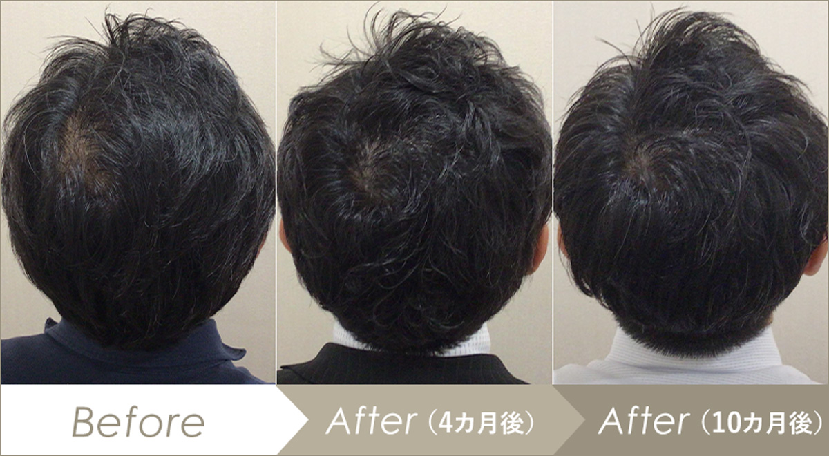 AGA治療（男性型脱毛症）の施術例-症例写真