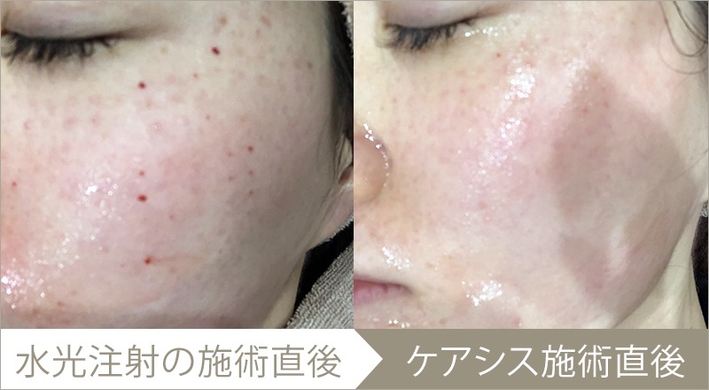 ケアシスの施術例(1回)-症例写真