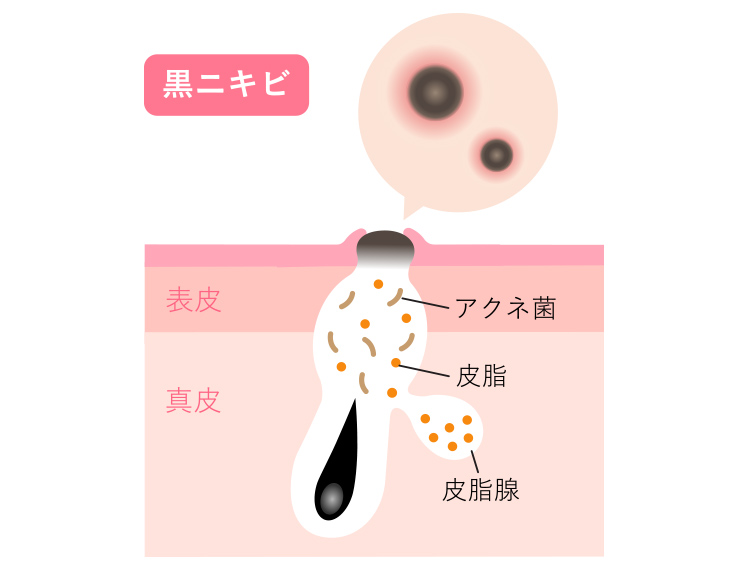 黒ニキビとは毛穴が開き、溜まった皮脂や老廃物が酸化し、黒くなった状態