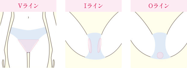 介護脱毛のVライン