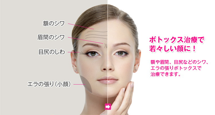 ボトックスで小顔に!