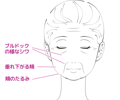 しわ・頬のたるみなど、顔のお悩み