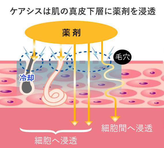 ケアシスは肌の真皮下層に薬剤を浸透