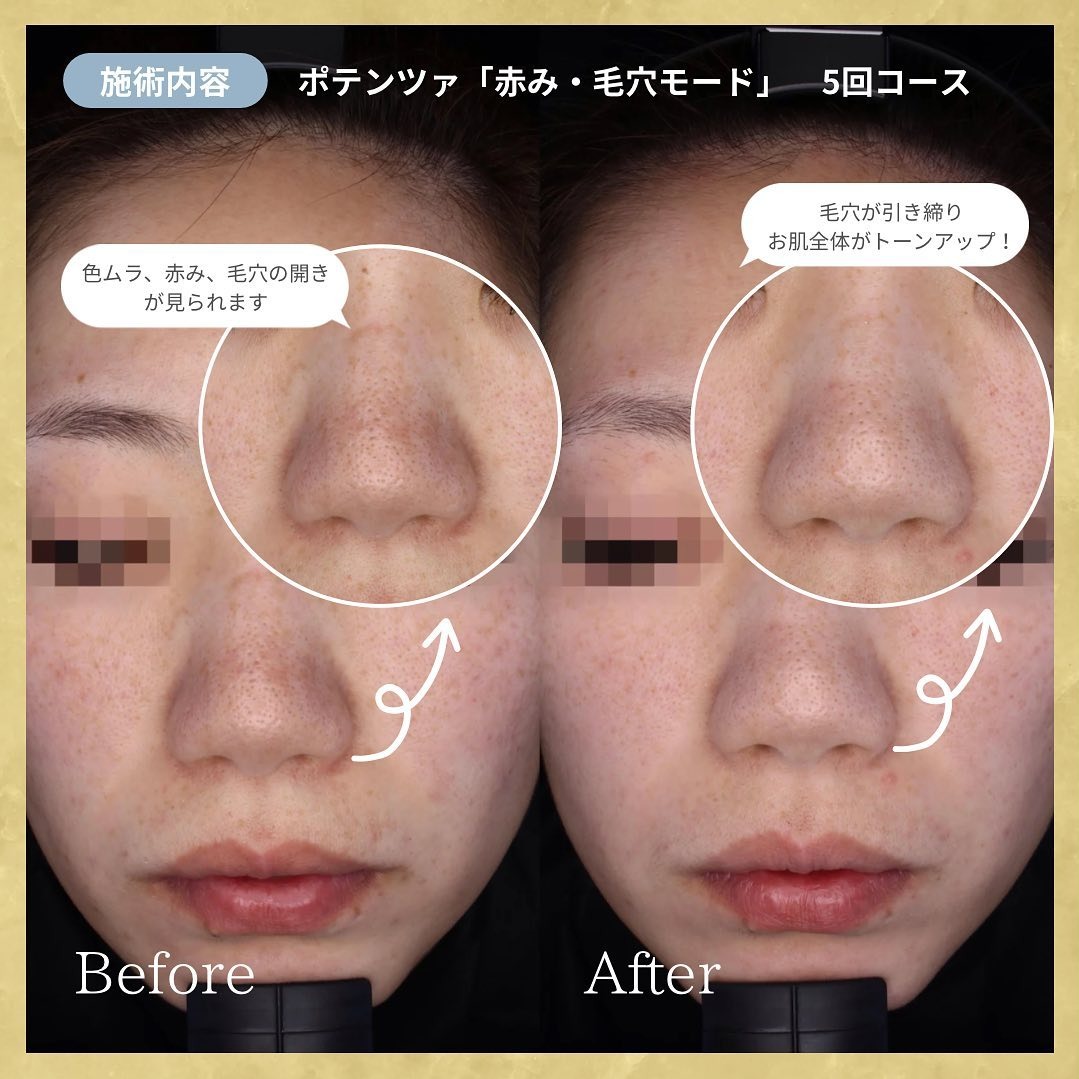 ポテンツァの症例写真