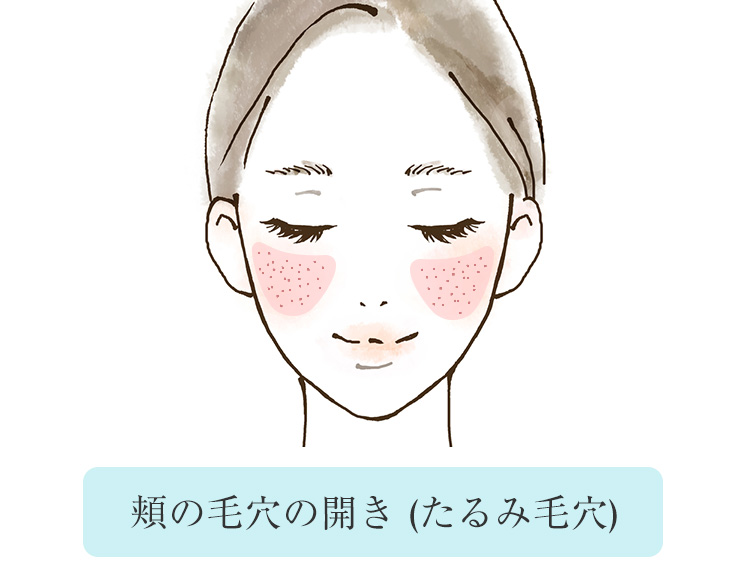 頬の毛穴の開きはたるみ毛穴