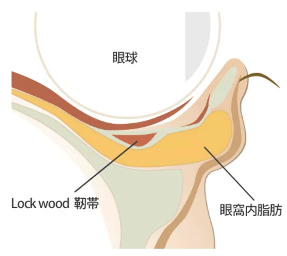 目の下の脂肪が前に出る（目袋）説明図
