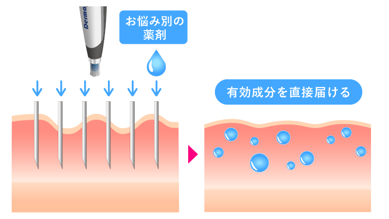 ダーマペン4×薬剤でさまざまな肌悩みに対応できる