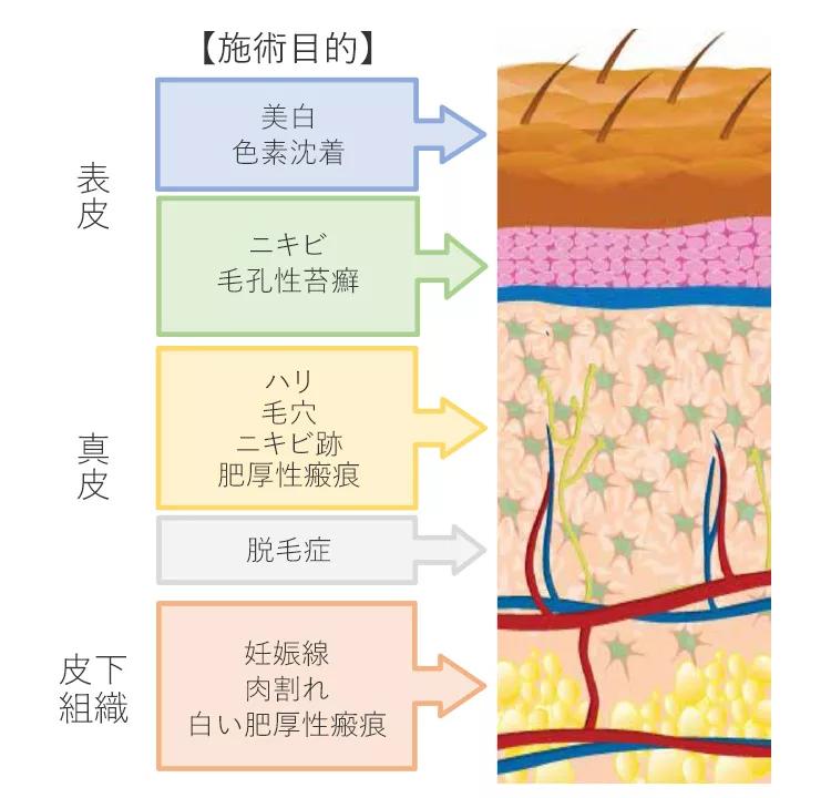 ダーマペン4の針は25段階に調整可能