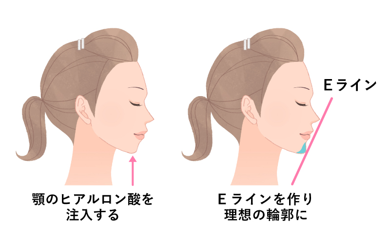 顎にヒアルロン酸を注入すると、理想のEラインになります