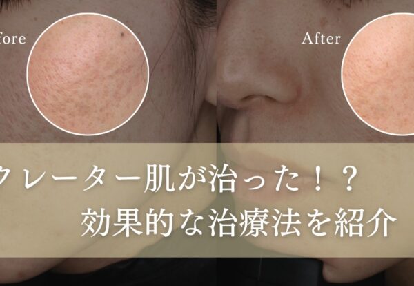 クレーター肌が治った！？効果的な治療法を紹介